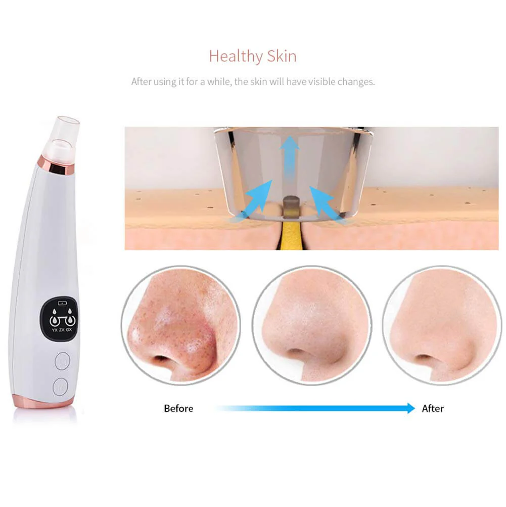 Acne Cleansing Blackhead Remover - Image 4